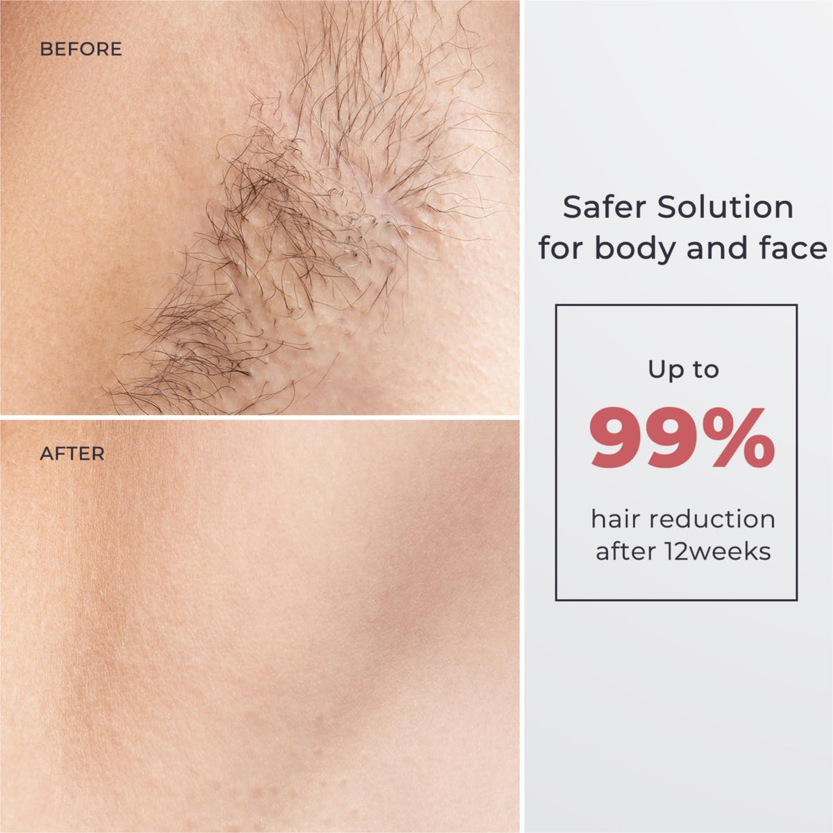 Intense Pulsed Light (IPL) Laser Hair Removal Device in White & Pink NEW